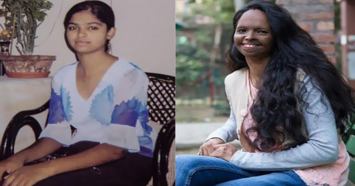 एसिड अटैक से पहले इतनी खूबसूरत दिखती थी लक्ष्मी अग्रवाल Youth Express