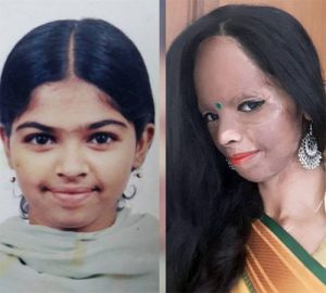 एसिड अटैक से पहले